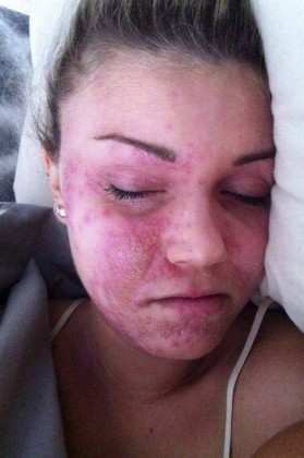 eczema-miss.jpg