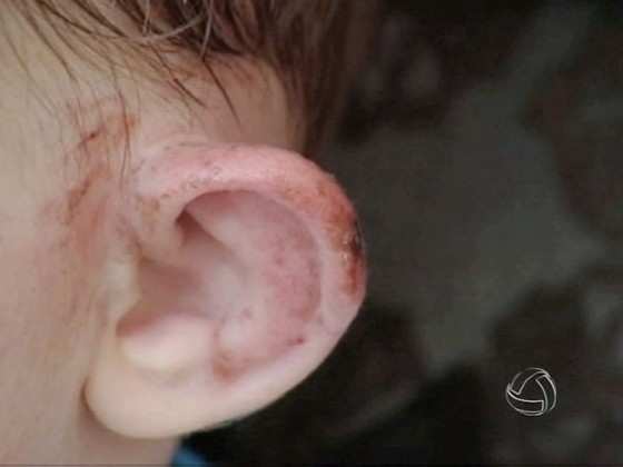 Quando crescer um pouco mais, a vítima vai ter ainda que passar por cirurgia de reparação