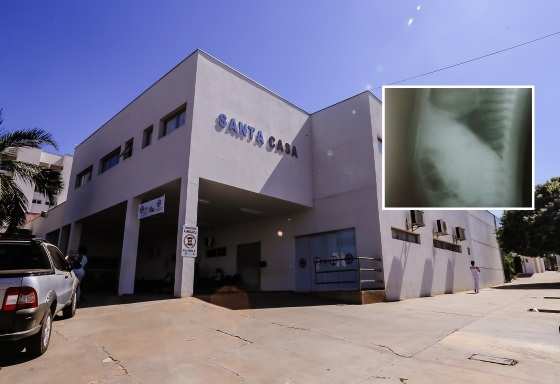 Exames mostram as agulhas no corpo da bebê, que está internada na Santa Casa de Rondonópolis