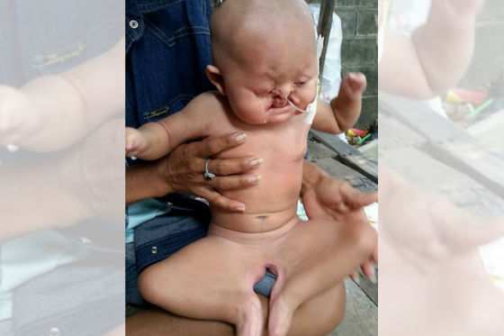 Ainda não se sabe o sexo exatamente por essa doença