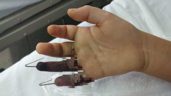 Mesmo após cirurgia, dedo anelar deverá ser amputado nesta sexta-feira (19