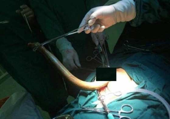 Cirurgia para a retirada de enguia do interior de paciente na China 