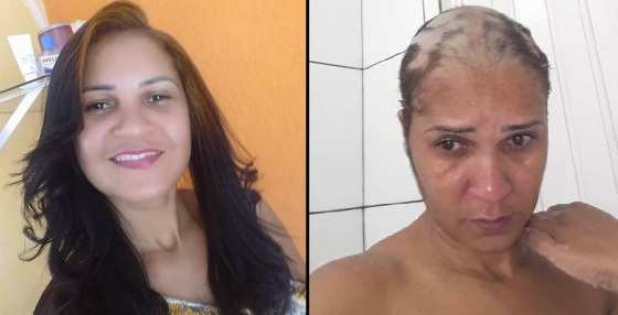 Cabeleireira Katiane Muniz perdeu todo o cabelo após usar produto para alisamento de cabelo, sem testar antes.