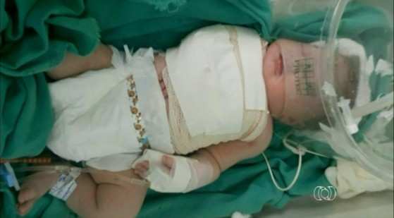 Médicos esperavam menino nascer com 2,6 kg, mas criança pesava mais de 4,6 kg.
