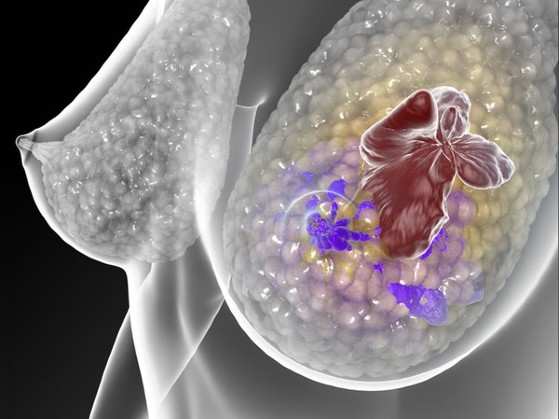 Tumor de mama foi um dos cânceres estudados por pesquisadores. Cientistas acreditam que genoma tem genes específicos de prevenção
