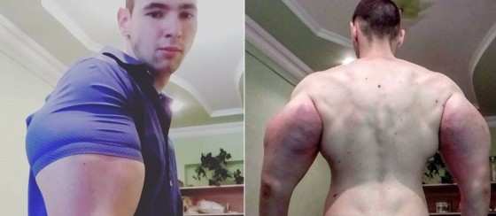 Kirill Tereshin 21 anos injetou no corpo um óleo conhecido como synthol