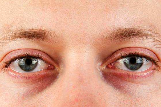 Mas olheiras também podem ser sintomas de problemas mais graves: a falta de ferro no sangue, por exemplo.