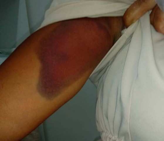 Hematoma no braço da mulher que foi agredida por assaltante no Bonfim, em Salvador