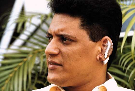 Wellington Camargo após implante de parte da orelha, em Goiânia