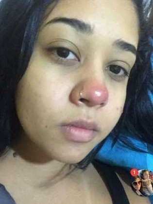 Um dos primeiros sintomas da infecção sofrida por Layane Dias foi uma 'bola vermelha' no nariz 