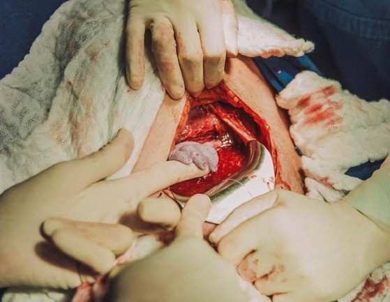 A pequena Luana segurando a mão da obstetra antes mesmo de nascer