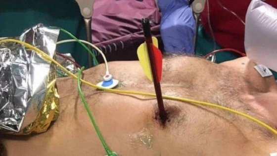 Cirurgia para a retirada da flecha em hospital de Turim