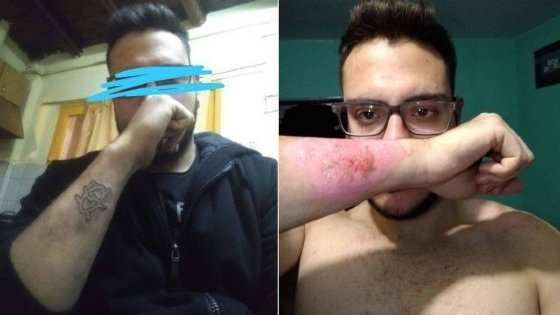 Argentino que removeu tatuagem com ralador de queijo 