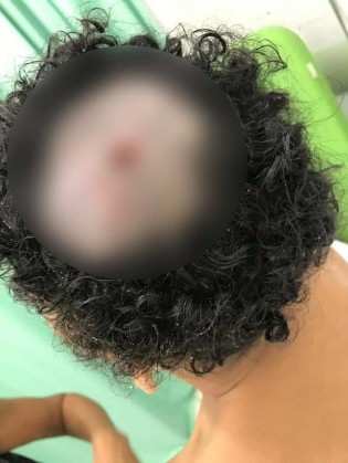 Menina de sete anos foi internada com uma lesão causada por parasitas na cabeça em Praia Grande, SP —