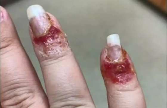 Fungos atacaram as mãos dela, deixando o local sangrando e cheio de pus