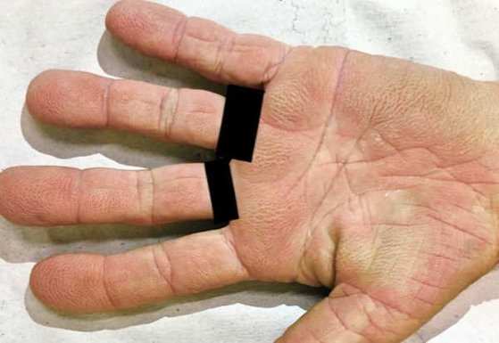 Brasileira tem rara condição de mãos aveludadas ligada ao câncer 