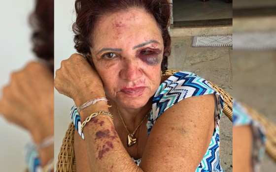 Ex-primeira dama de Itaberaí, Eleni Soares, de 71 anos, mostra marcas de agressão após assalto.