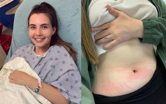 A jovem de 21 anos, moradora da Califórnia, tem alergia à água, causando erupções extremamente dolorosas