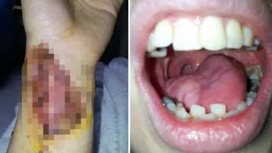 Stephanie Wigglesworth com a nova língua, retirada de antebraço 