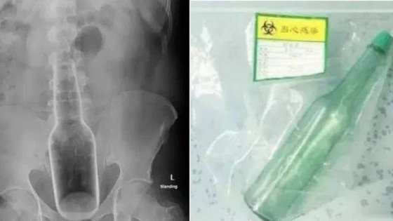 Vidro de perfume dentro do corpo de paciente chinês
