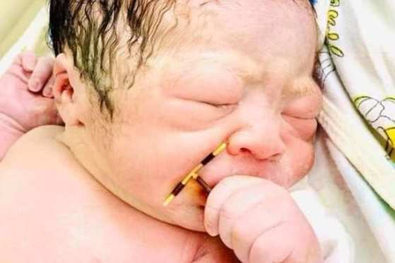 O obstetra responsável pelo parto, Tran Viet Phuong, disse que o menino segurava firmemente o DIU quando nasceu