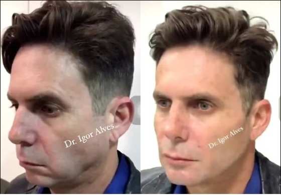 O cantor aparece antes do procedimento e, logo depois, a grande transformação