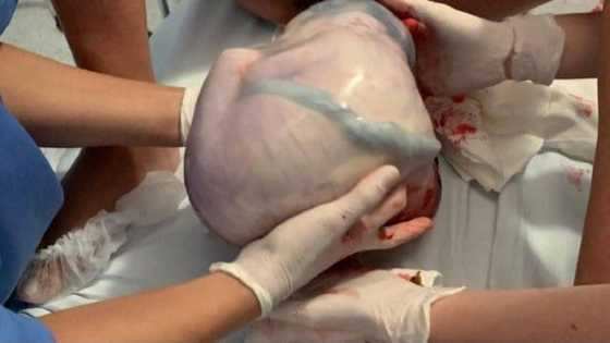 Bebê nasce dentro da bolsa em parto empelicado