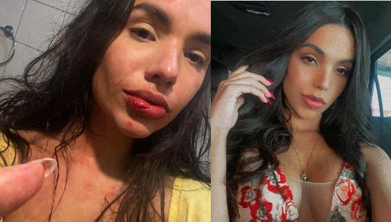 Kedma apareceu machucada em seu Instagram pedindo por socorro.