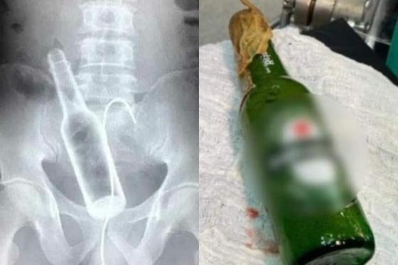 Jovem passou por cirurgia para retirar a garrafa.