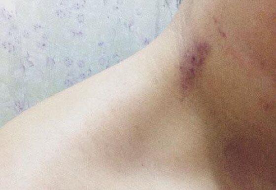 Mulher denuncia ex-marido que deixou marca de chupão durante discussão.