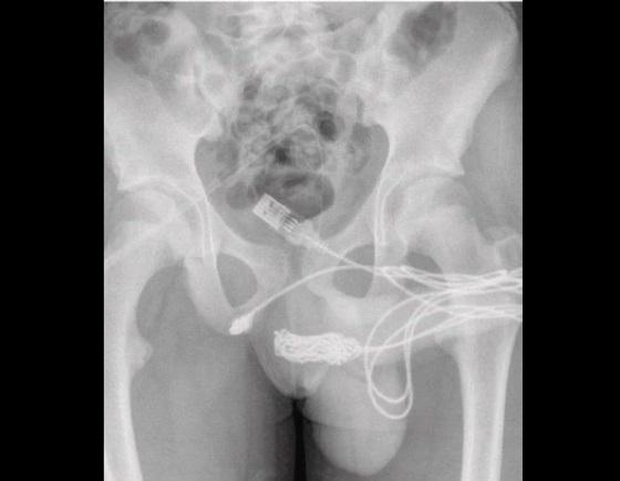 Radiografia da região pélvica do menino de 15 anos