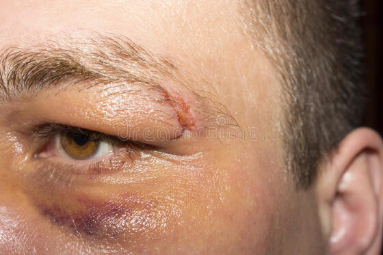 Homem ficou com o olho roxo, após levar vários socos da sogra