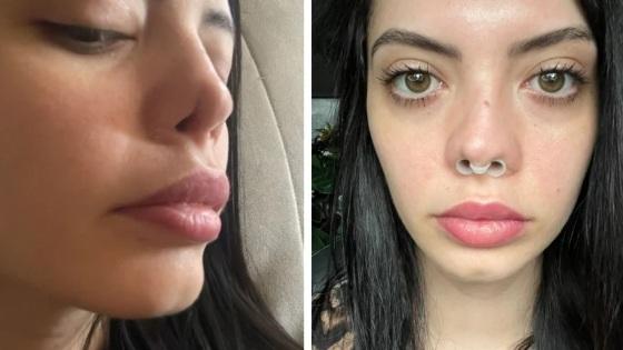 Sarah Cardoso chegou a ser processada pelo médico que cometeu o erro após divulgar a sua história nas redes sócias. No entanto, o profissional perdeu a ação