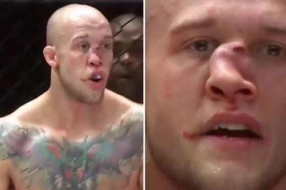 O norte-americano Blake Perry enfrentava Marcel McCain quando seu adversário acertou um chute em cheio no seu nariz, que acabou fraturado