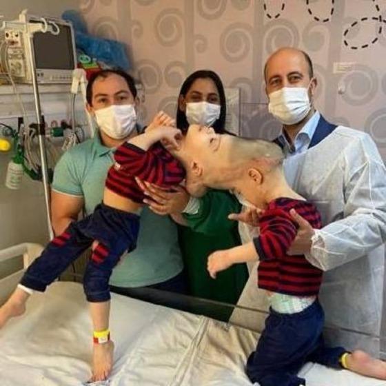 Gêmeos passaram por uma cirurgia de 27 horas