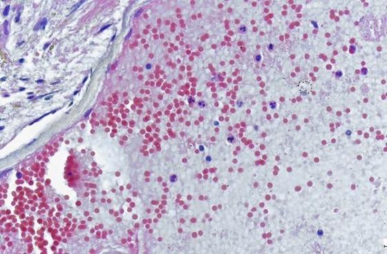 Duas enfermeiras podem ter sido contaminadas com a monkeypox ao ter contato com superfícies contaminadas