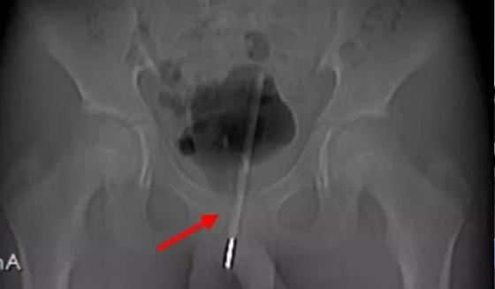 Com medo de que o objeto atingisse outros órgãos, os profissionais optaram por uma cirurgia menos invasiva