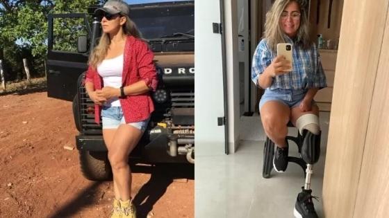 Indialma foi submetida a cirurgia em julho de 2021, passou 20 dias em coma e sofreu amputações por causa de necrose nos membros