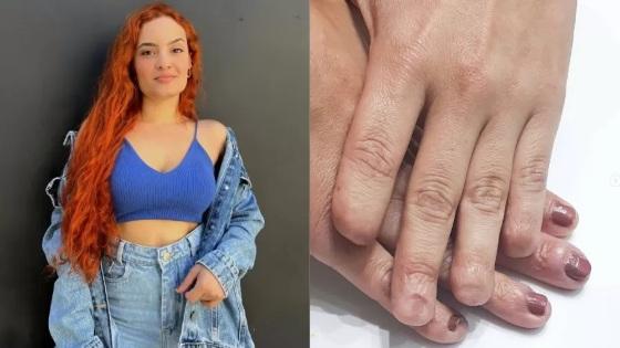 Jaine Silvestre teve complicação em cirurgia que deveria ser simples, para retirada de cisto no ovário