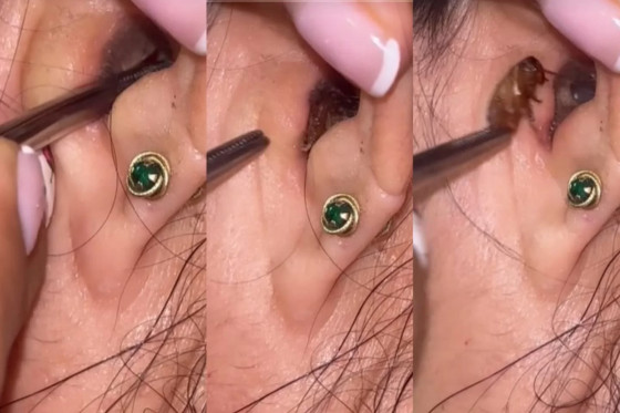 O vídeo do momento em que a barata é puxada com pinças do ouvido da paciente viralizou no TikTok