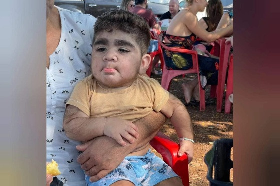 O bebê possui pelos em excesso, especialmente no rosto, aparentando ter uma barba
