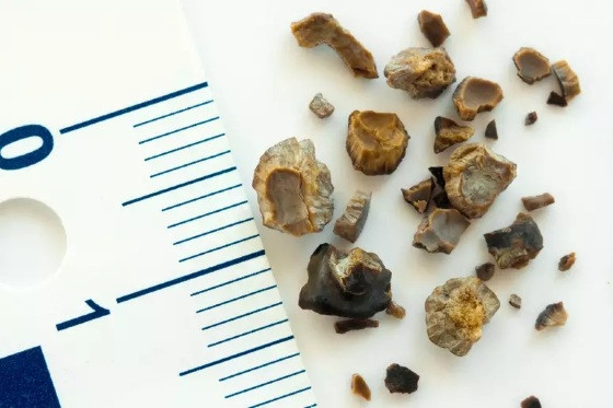 Imagens de pedras retiradas dos rins de um paciente após cirurgia.