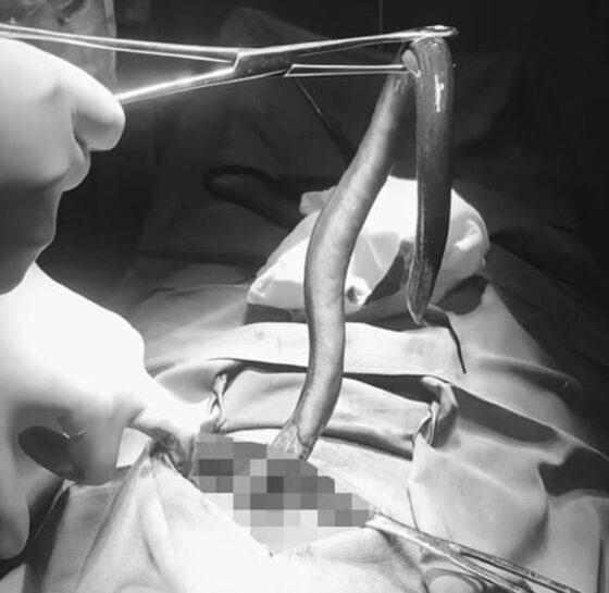 Os médicos acreditam que a enguia entrou pelo ânus, deslizou pelo cólon e de alguma forma entrou no estômago 