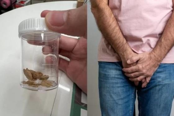 Acúmulos de esmegma (células mortas) na glande do homem começaram a cair do pênis