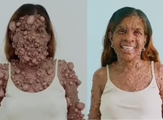 Natural de Trinidad e Tobago, a mulher tem um grave caso de neurofibromatose NF-1