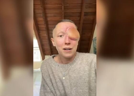 Californiana, de 28 anos, precisou ter o olho direito removido 