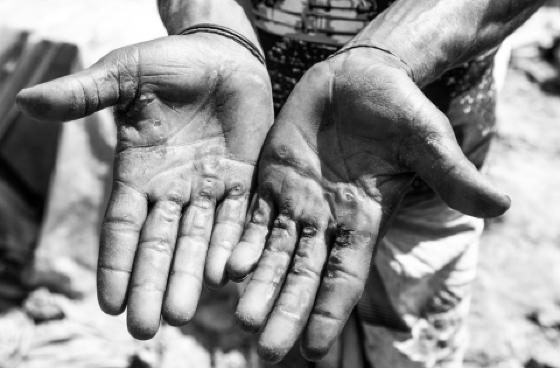 Empregado teve parte da visão comprometida por conta de uma infecção não tratada.