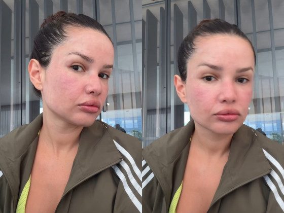 Juliette mostra rosto inchado após procedimento
