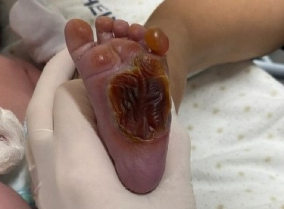 Bebê teve o pé queimado no Hospital Estadual Dr. Jayme Santos Neves horas após o nascimento