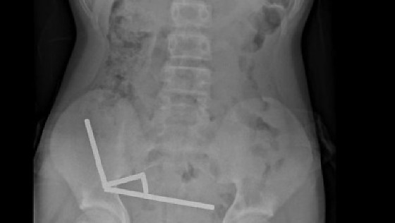 Raio-x abdominal do menino que engoliu entre 80 e 100 ímãs de alta potência